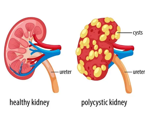 Comparison of a healthy kidney and a polycystic kidney affected by the disease."